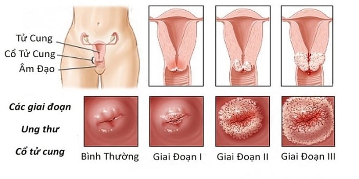 cac giai doan ung thu co tu cung