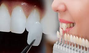 Dán răng sứ veneer là một trong các loại răng sứ được ưa chuộng hiện nay