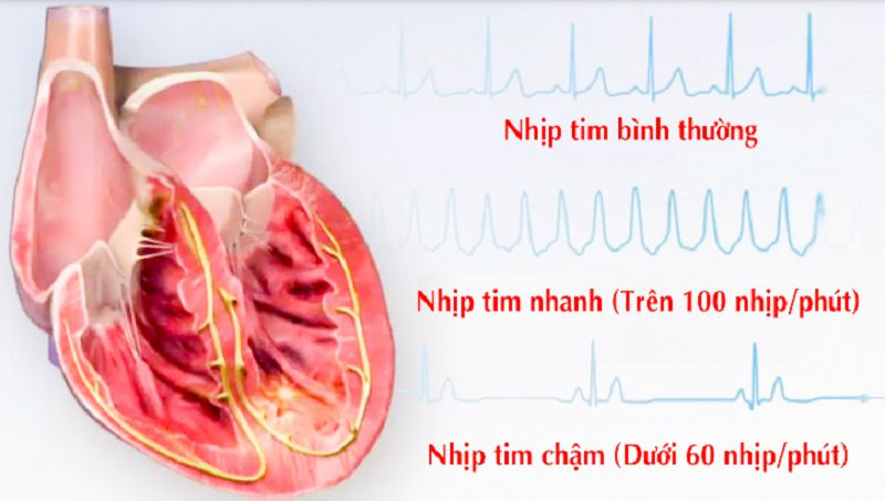 Rối loạn nhịp tim có phải là bệnh nghiêm trọng không?