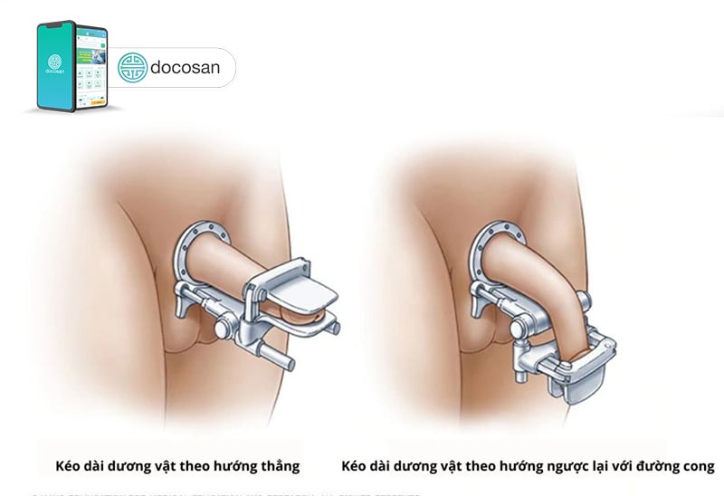 điều trị dương vật bị cong