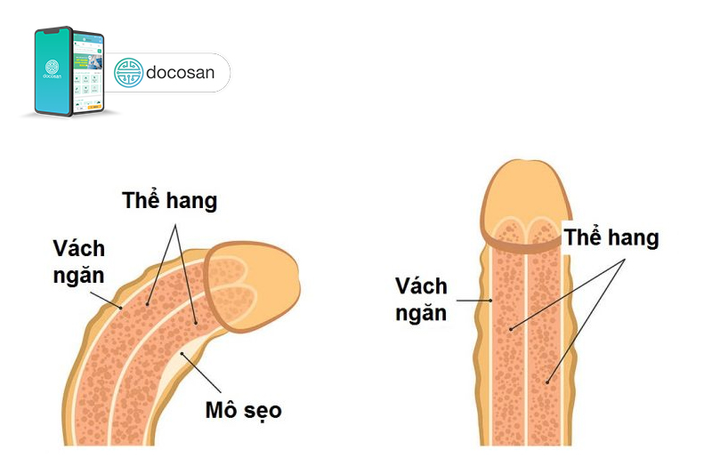 dương vật cong