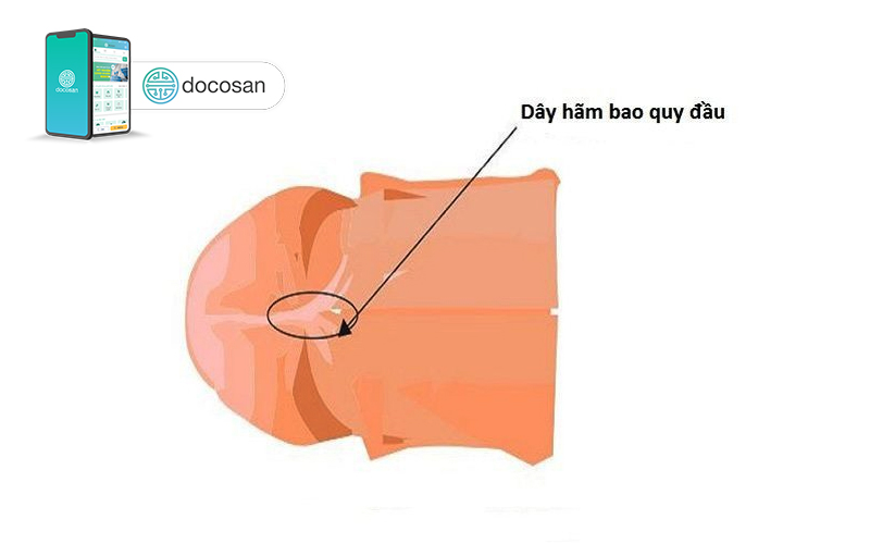 đứt dây hãm bao quy đầu