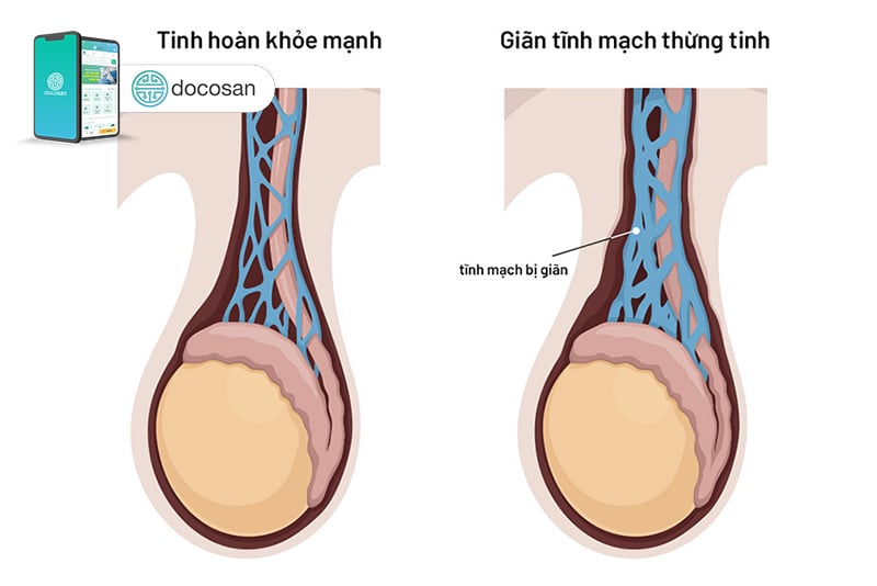 giãn tĩnh mạch thừng tinh