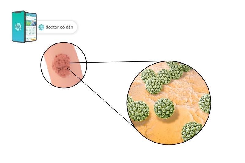 Virus u nhú ở người (HPV)