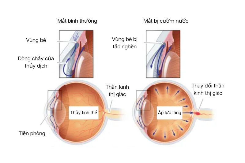 Giải phẫu của mắt bình thường và mắt bị cườm nước góc mở (Nguồn ảnh)