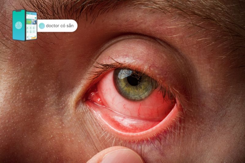 Đau mắt dữ dội hoặc đỏ mắt có thể là triệu chứng bệnh cườm nước góc đóng cấp tính