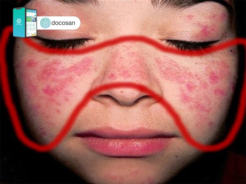 lupus ban đỏ hệ thống