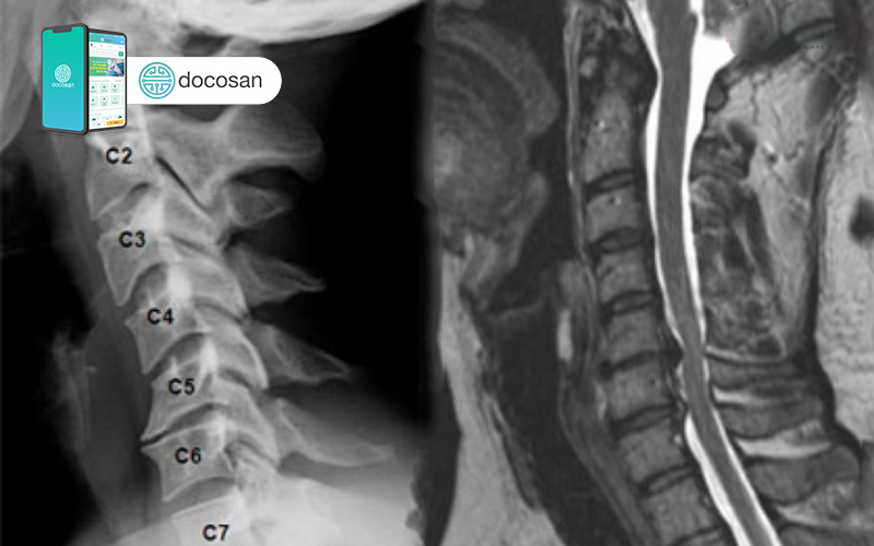 thoái hóa đốt sống cổ là bệnh lý mãn tính về xương khớp