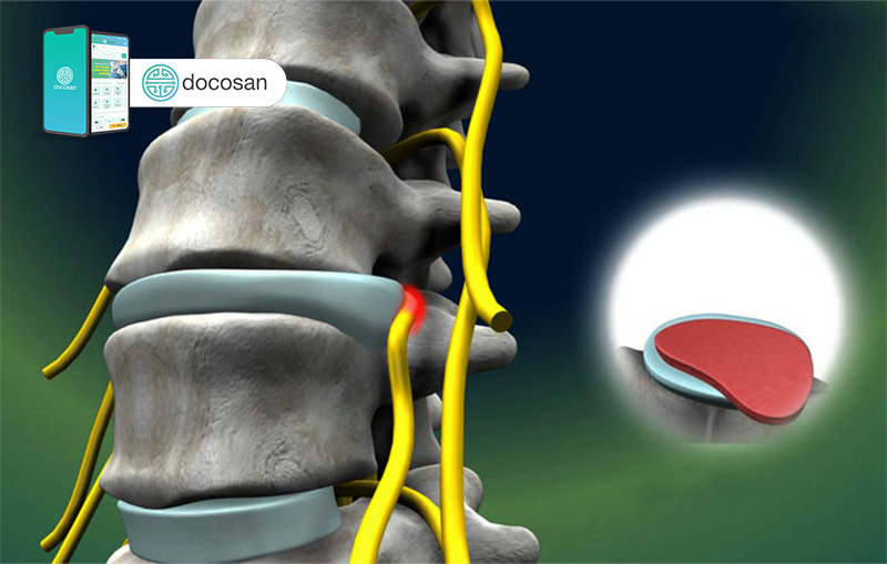 thoái hóa đốt sống cổ