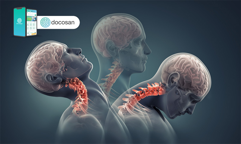 thoái hóa đốt sống cổ