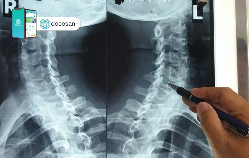 thoái hóa đốt sống cổ