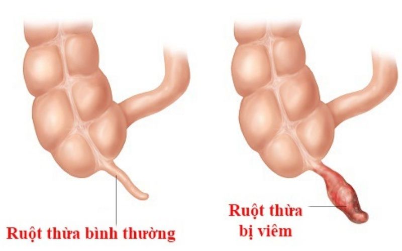 ruột thừa bị viêm