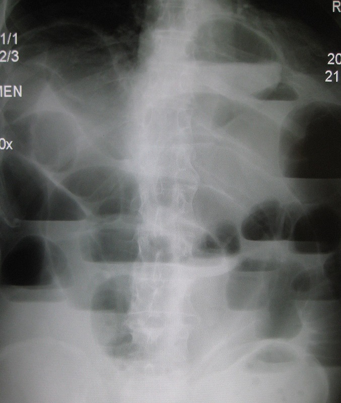 Hình ảnh tắc ruột trên phim X-quang