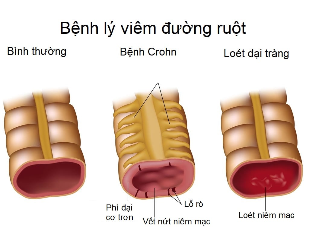 benh-crohn-o-tre-em