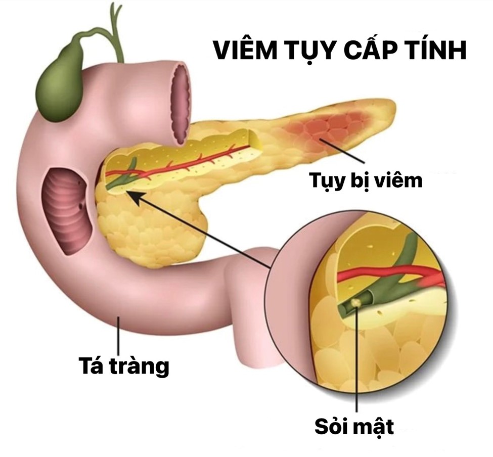 Viêm tụy cấp .1