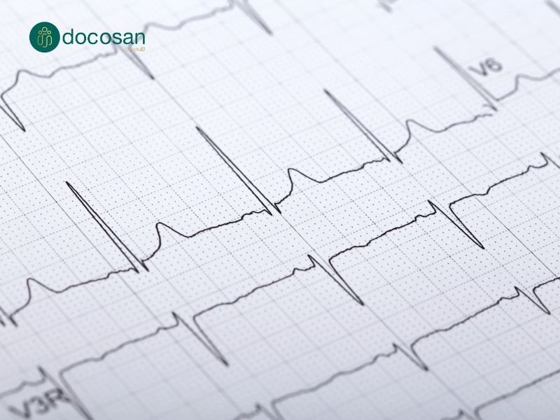 điện tâm đồ không có khả năng xác định nguyên nhân nhồi máu cơ tim