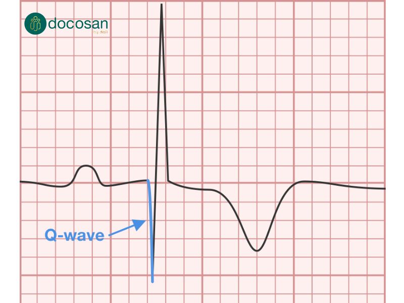 Hình ảnh sóng Q hoại tử trong nhồi máu cơ tim