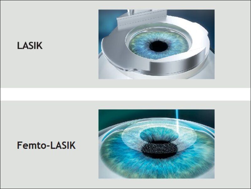 Femto Lasik là phiên bản cải tiến của LASIK, giúp tăng độ chính xác và giảm rủi ro