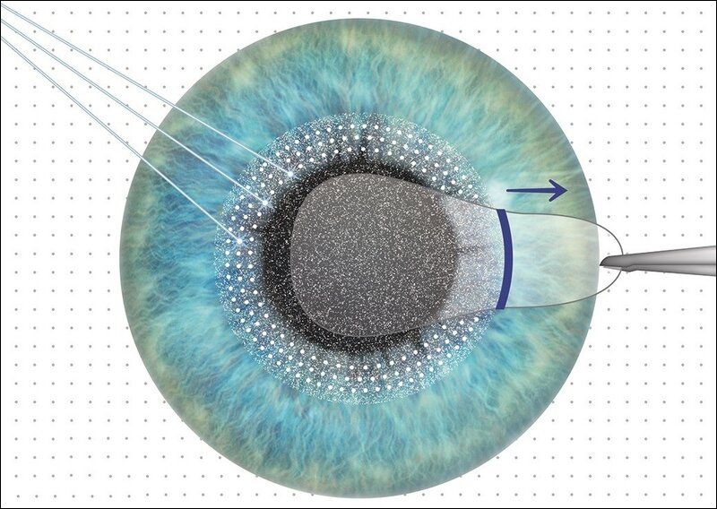 ReLEx SMILE là phương pháp mổ mắt tiên tiến bậc nhất hiện nay, không tạo vạt giác mạc