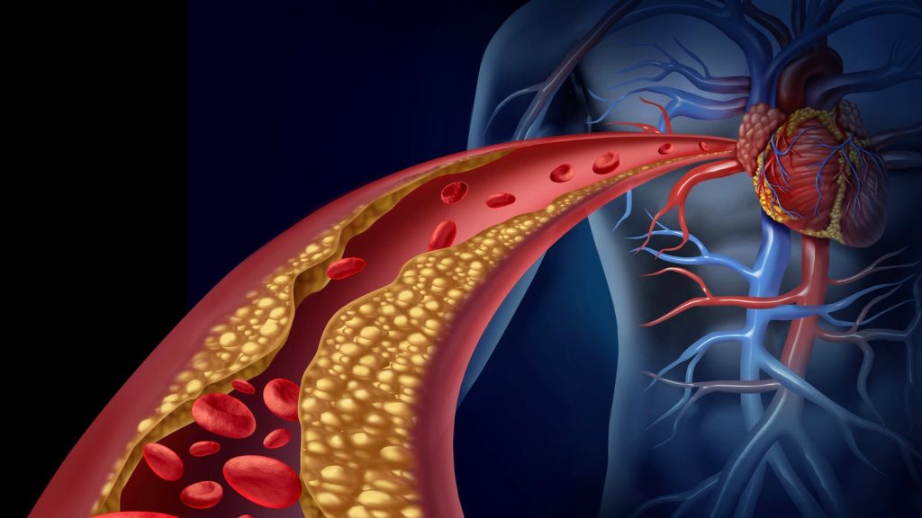 cholesterol-cao