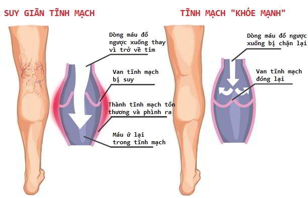 suy-gian-tinh-mach