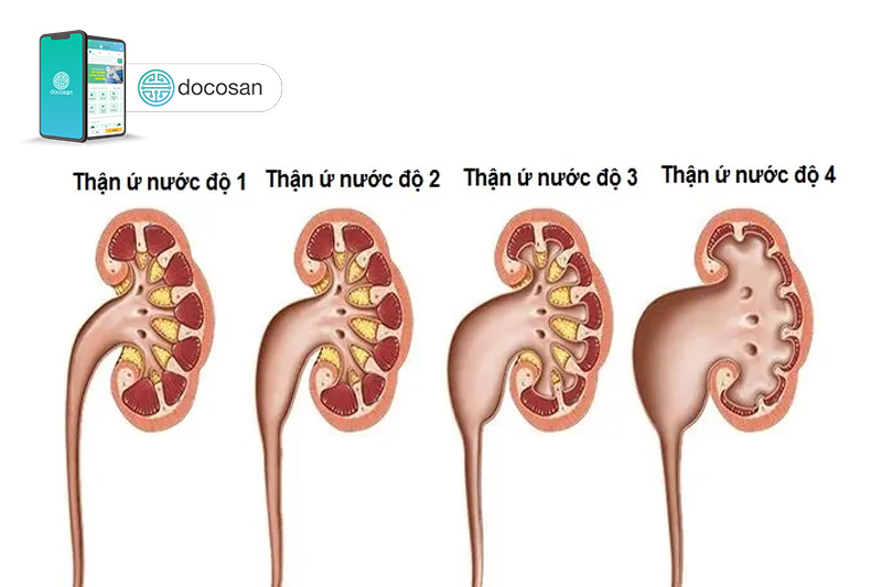 thận ứ nước độ 1