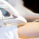 cấy que tránh thai ở đâu