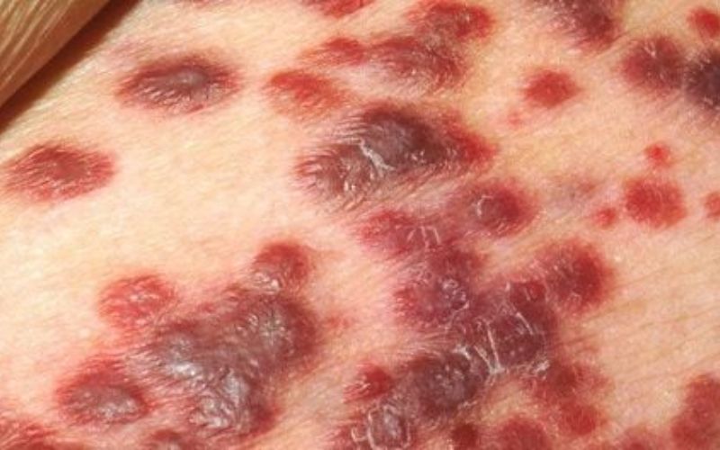 Một trong những sang thương thường gặp của bệnh giang mai