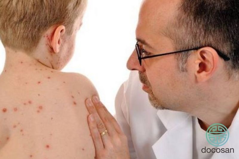 triệu chứng thuỷ đậu ở trẻ nhỏ