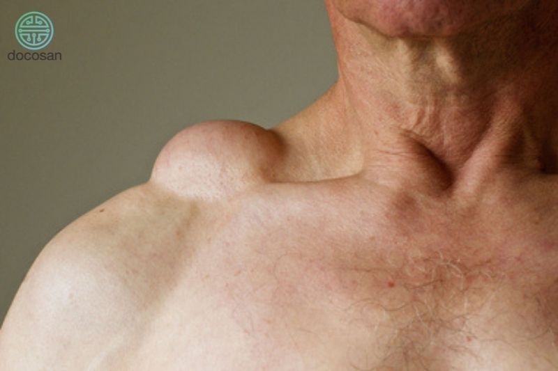 Kiến thức về u mỡ ở vai có thể bạn chưa biết Doctor có sẵn