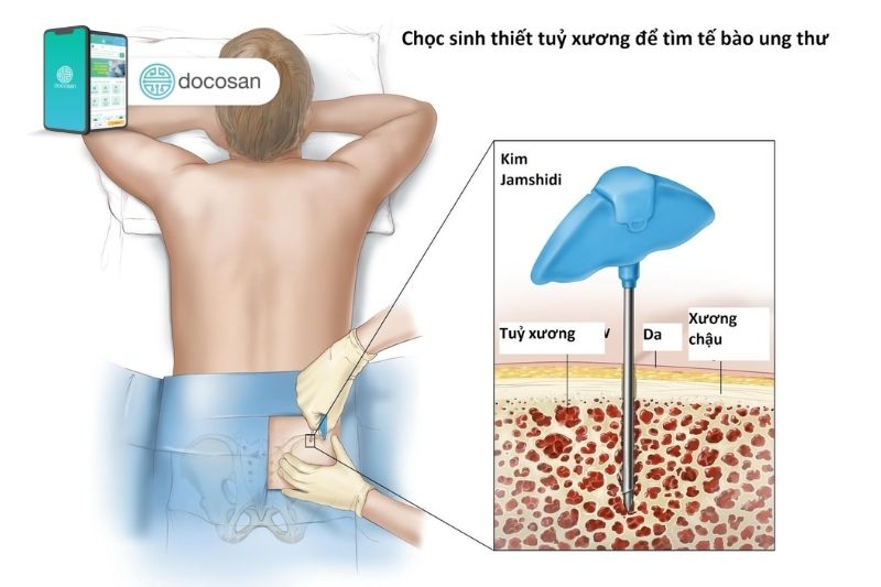 giảm tiểu cầu vô căn