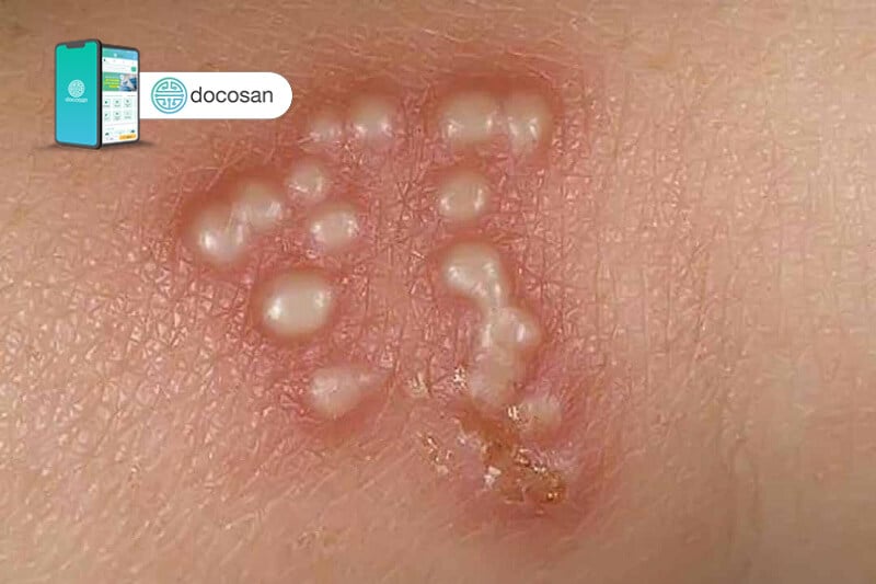 Mụn rộp trên da do virus lây truyền qua đường nước bọt gây nên