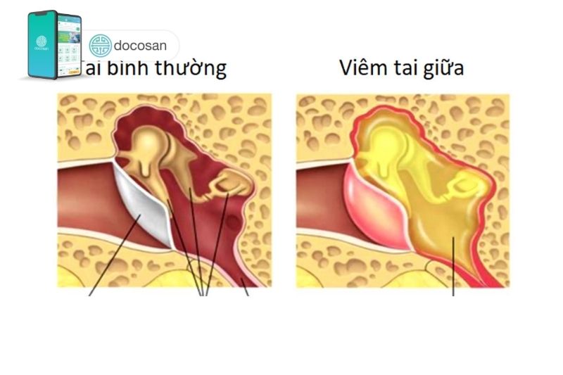 Tai bị ù 1 bên