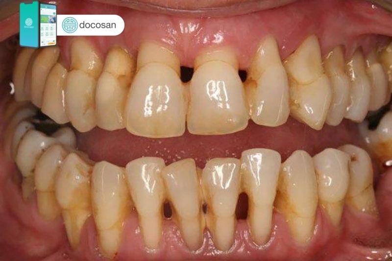 viêm chân răng có mủ