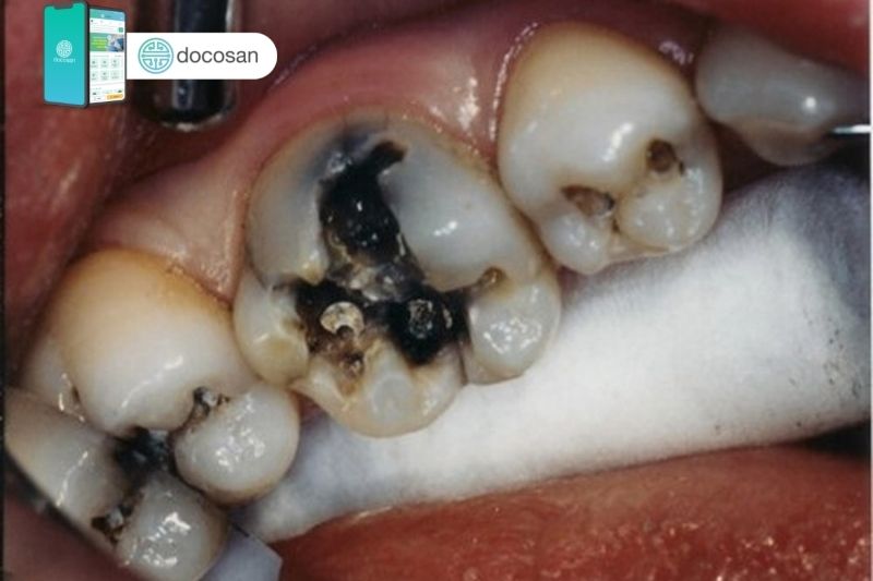 viêm chân răng có mủ