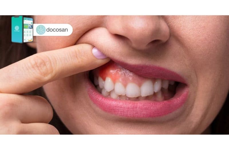 viêm chân răng có mủ