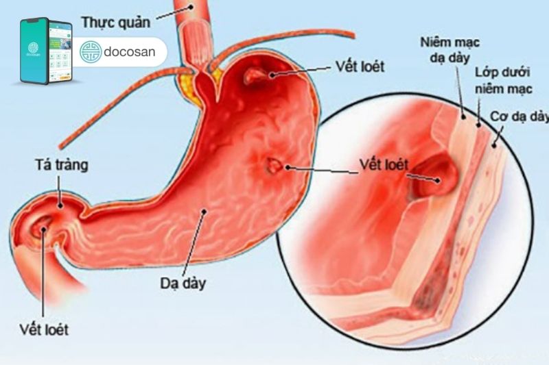 Bệnh viêm phù nề dạ dày là gì?