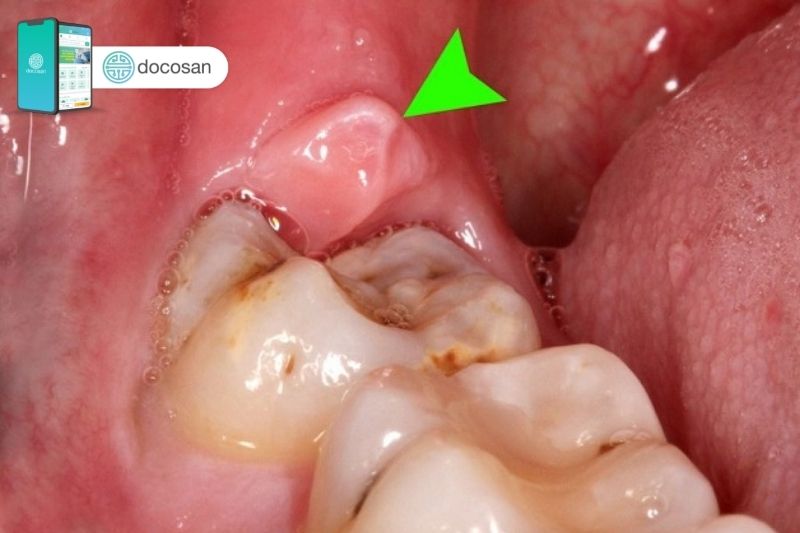 Vệ sinh răng miệng đúng cách sẽ giúp cải thiện sưng nướu răng