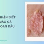 Sùi mào gà giai đoạn đầu ở nam, nữ có chữa khỏi không? Các nhận biết