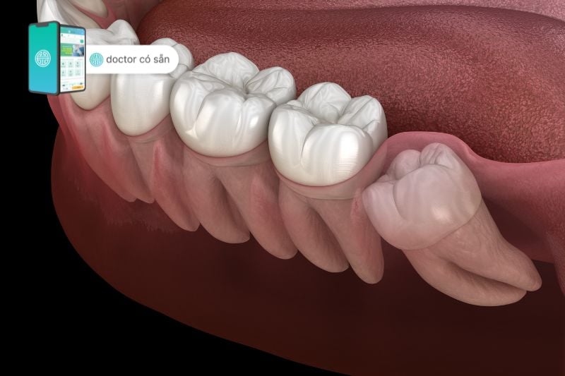 Đau răng cấm là bệnh về răng thường gặp