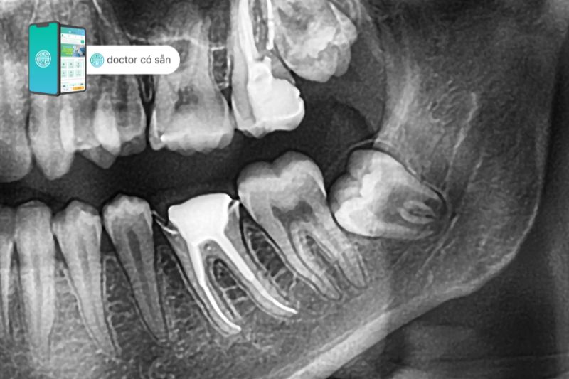 Sự xuất hiện của răng khôn là một trong những nguyên nhân gây đau răng cấm