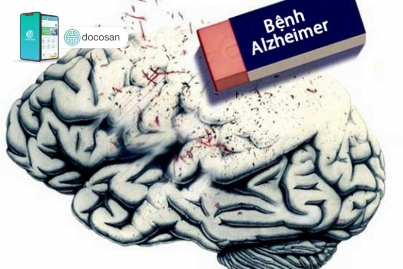 Các giai đoạn của bệnh Alzheimer