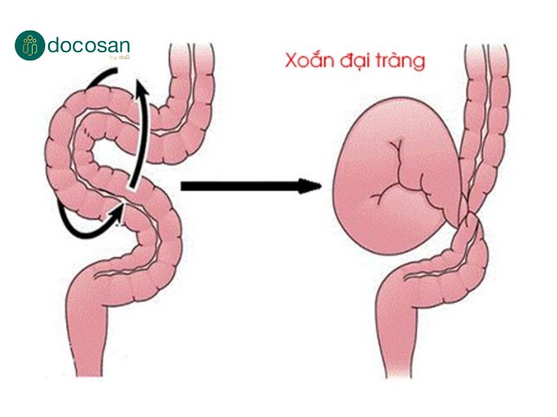 Nguyên nhân xoắn đại tràng sigma