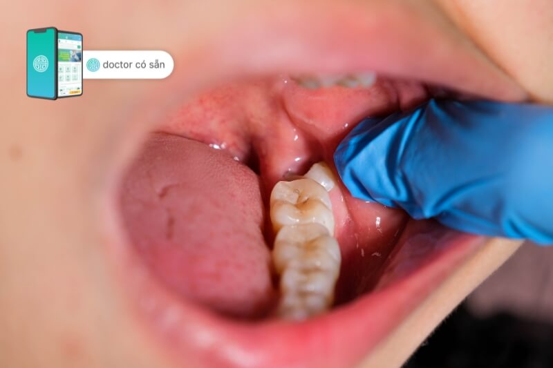 Việc nhổ răng khôn nguy hiểm như thế nào?