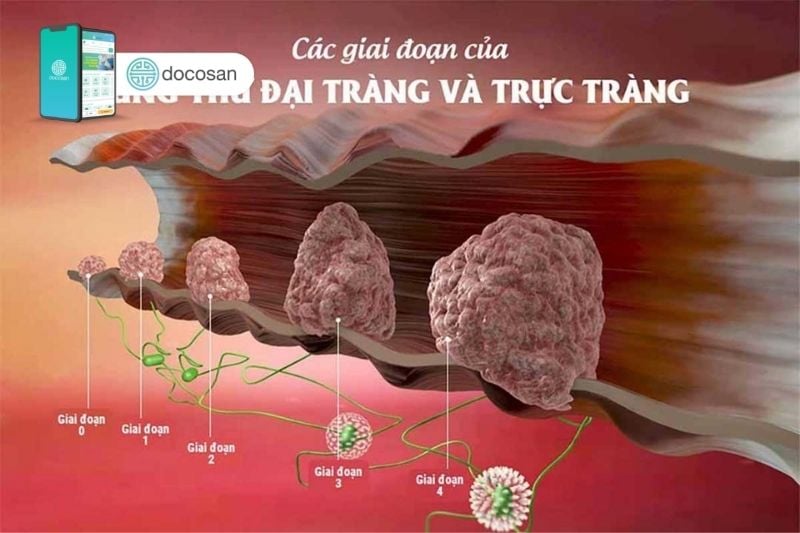 Ung thư trực tràng giai đoạn 2