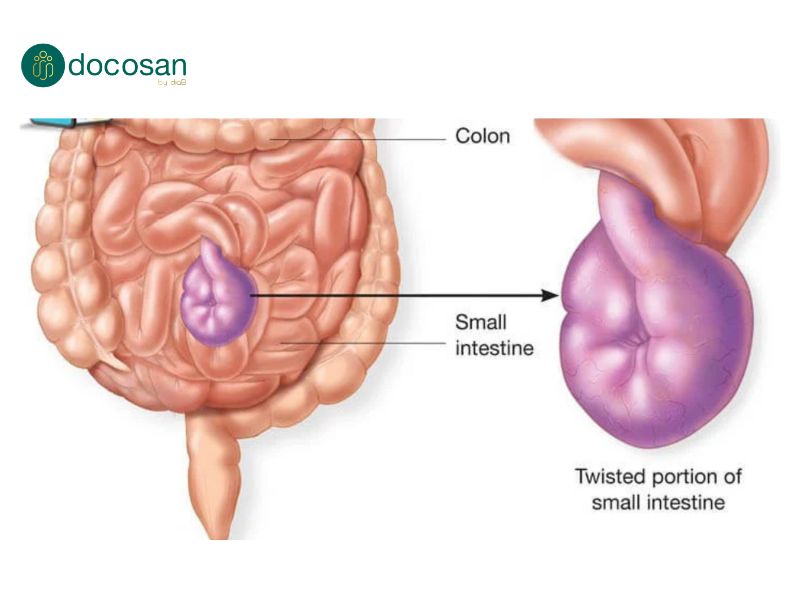 Xoắn đại tràng sigma