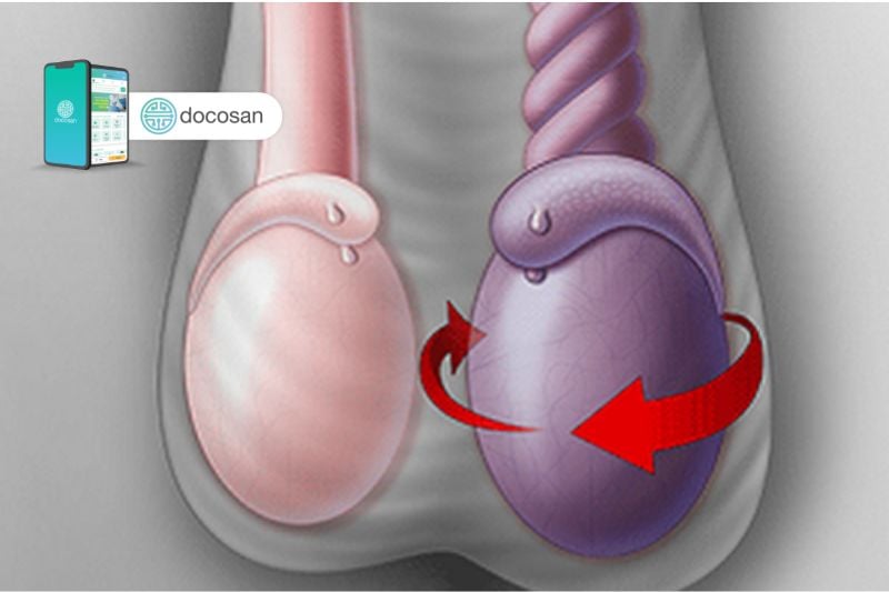 cách điều trị xoắn tinh hoàn tại nhà