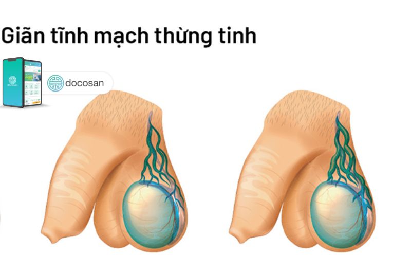 Giãn tinh hoàn