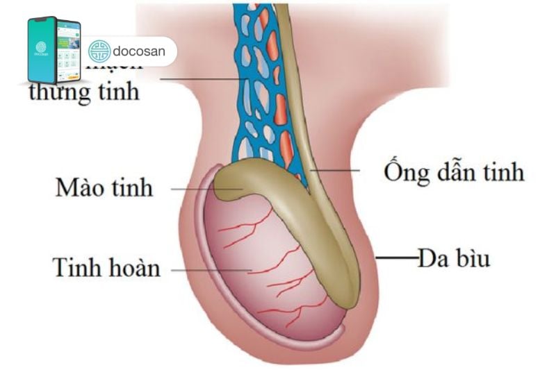 Giãn tĩnh mạch thừng tinh bên phải