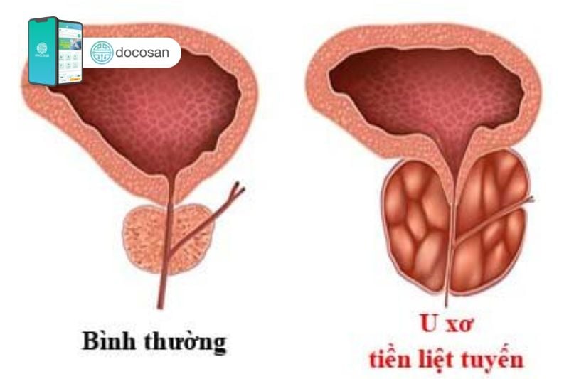 U xơ tiền liệt tuyến